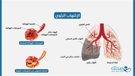 أبرز أعراض الالتهاب الرئوي الحاد: