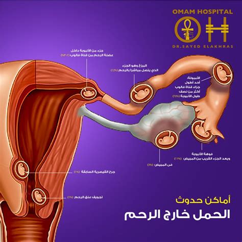 أسباب الحمل خارج الرحم