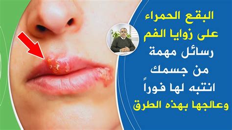 أسباب وعلاج الهربس الفموي