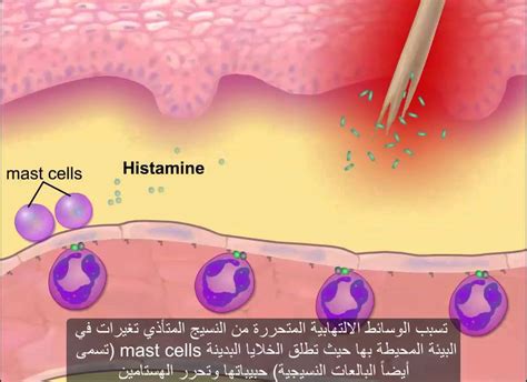 التهاب حاد