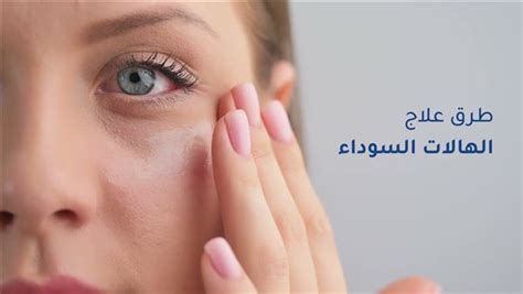 كيفية علاج الهالات السوداء