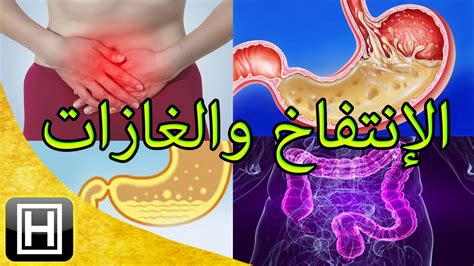 كيفية علاج انتفاخ البطن