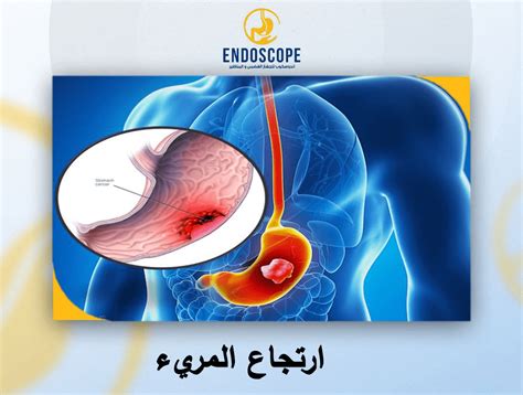 علاج ارتجاع المريء بالجراحة