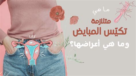 3-متلازمة المبيض المتعدد الكيسات: