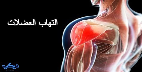 أعراض التهاب العضلات