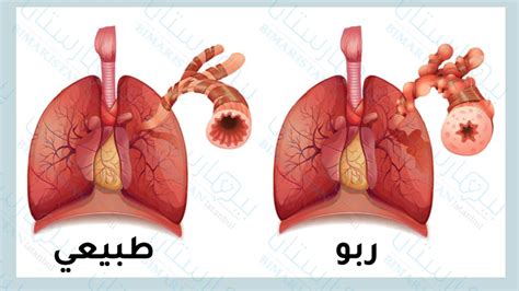 علاج الربو والتهاب الشعب الهوائية