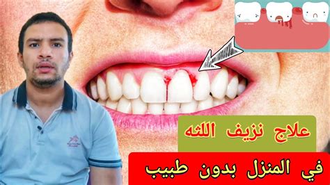 الأعراض الرئيسية لنزيف اللثة